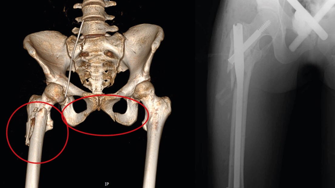Доктора в Сергиевом Посаде спасли упавшую с девятого этажа девушку