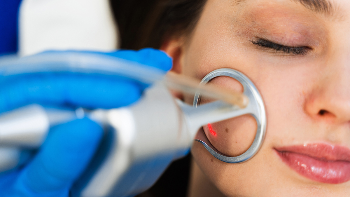 Почему CO₂-лазер считается «золотым стандартом» удаления бородавок