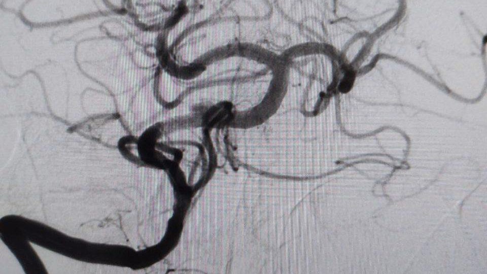 Врачи в Подмосковье спасли мужчину с редким «ночным» инсультом