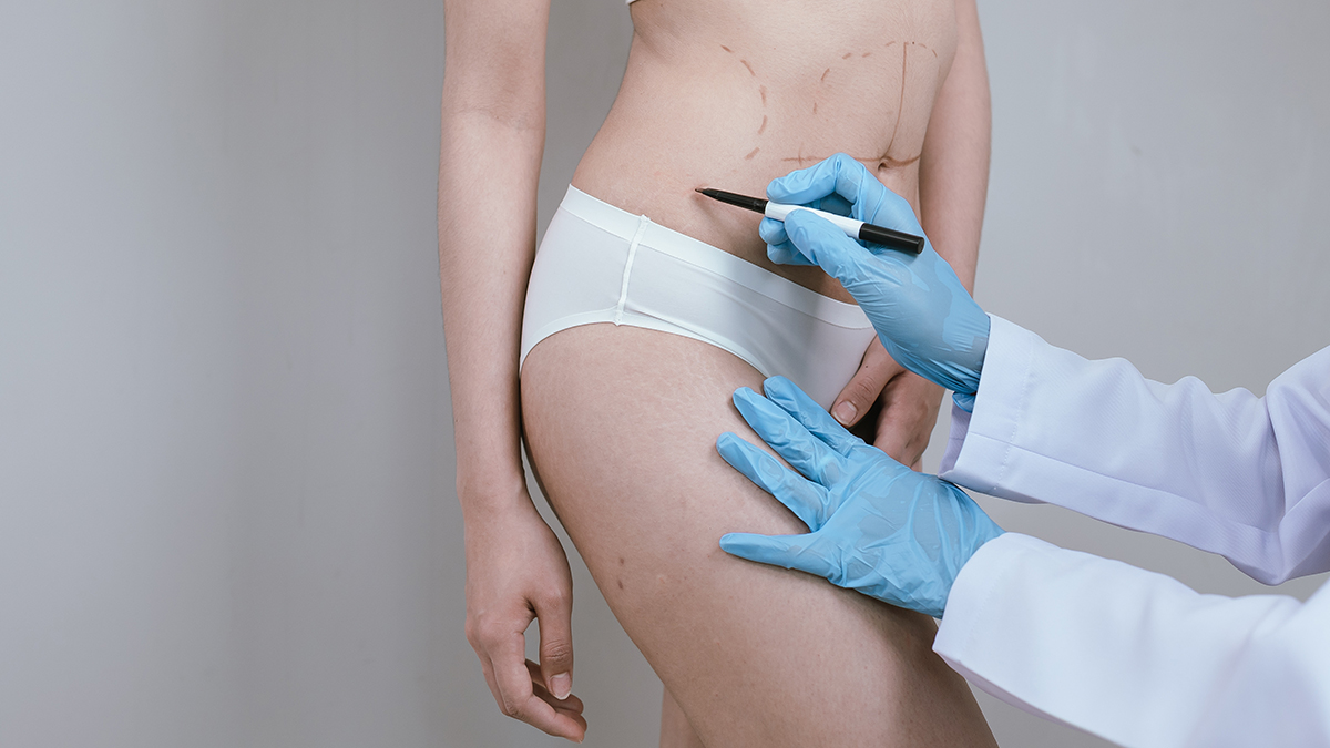 Липосакция и аспирация: что это за операции и насколько они опасны