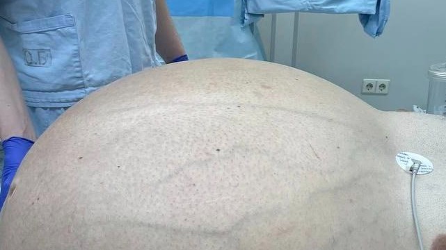 Российские врачи удалили у мужчины опухоль весом более 60 килограммов