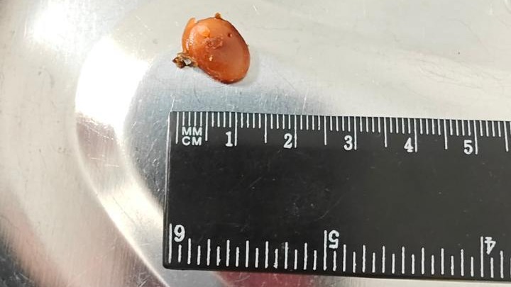 Подмосковные врачи вытащили у мужчины беруши, которые он носил два года