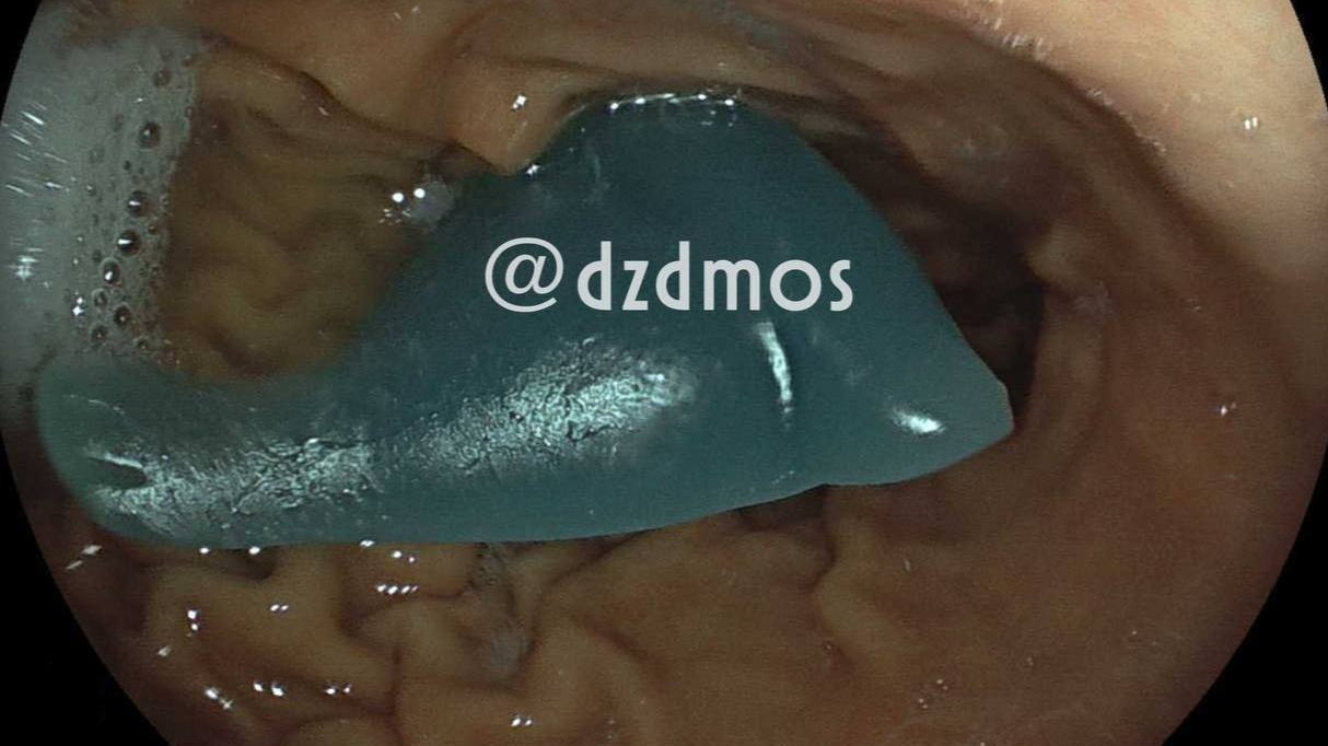 Московские врачи достали силиконового дельфина из желудка пятилетнего ребенка