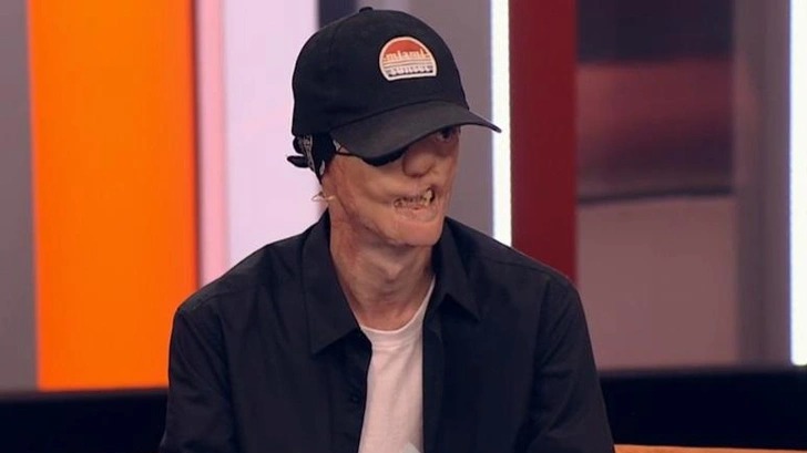 Потерявший лицо из-за укуса собаки в детстве мужчина обвинил в произошедшем мать