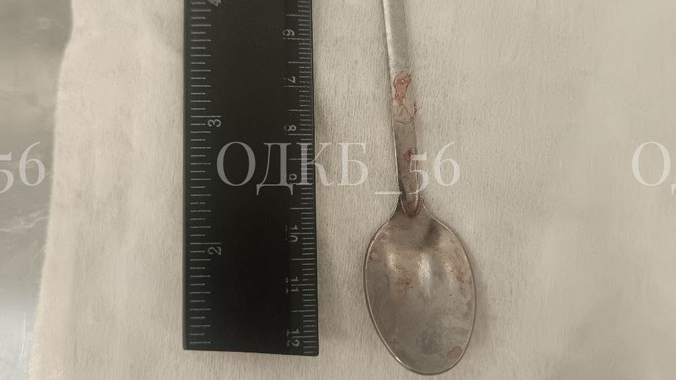 Ребенок проглотил 14-сантиметровую ложку в Оренбургской области