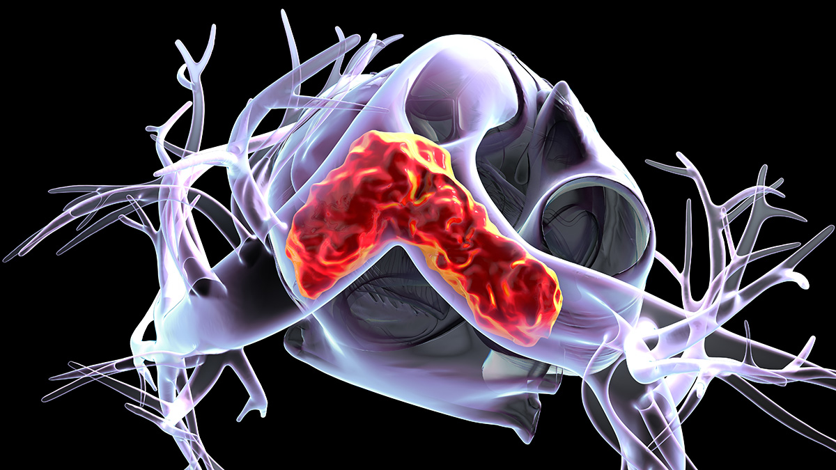 Тромбоэмболия легочной артерии: что это такое, почему возникает
