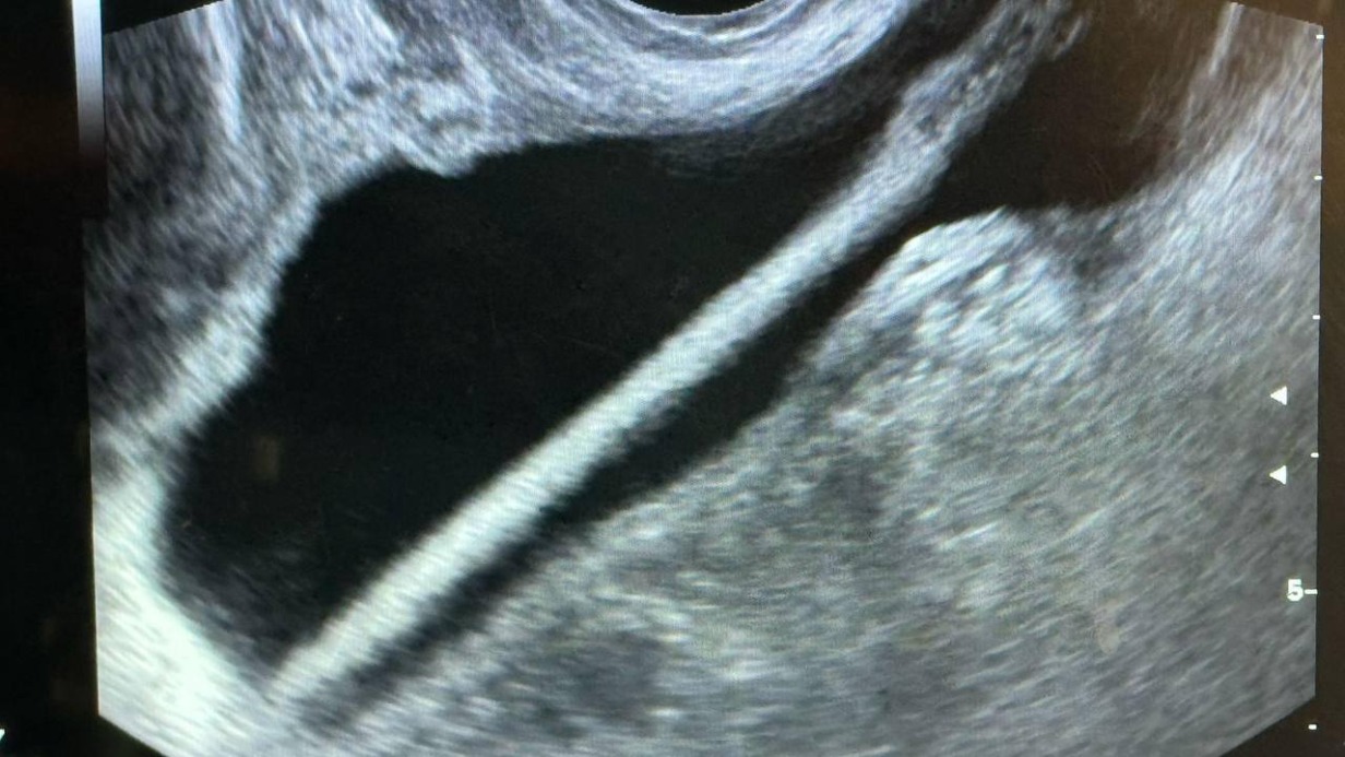 Подмосковные врачи извлекли косметический карандаш из мочевого пузыря женщины