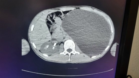 Новосибирские врачи удалили подростку почку размером с пятилитровую бутылку