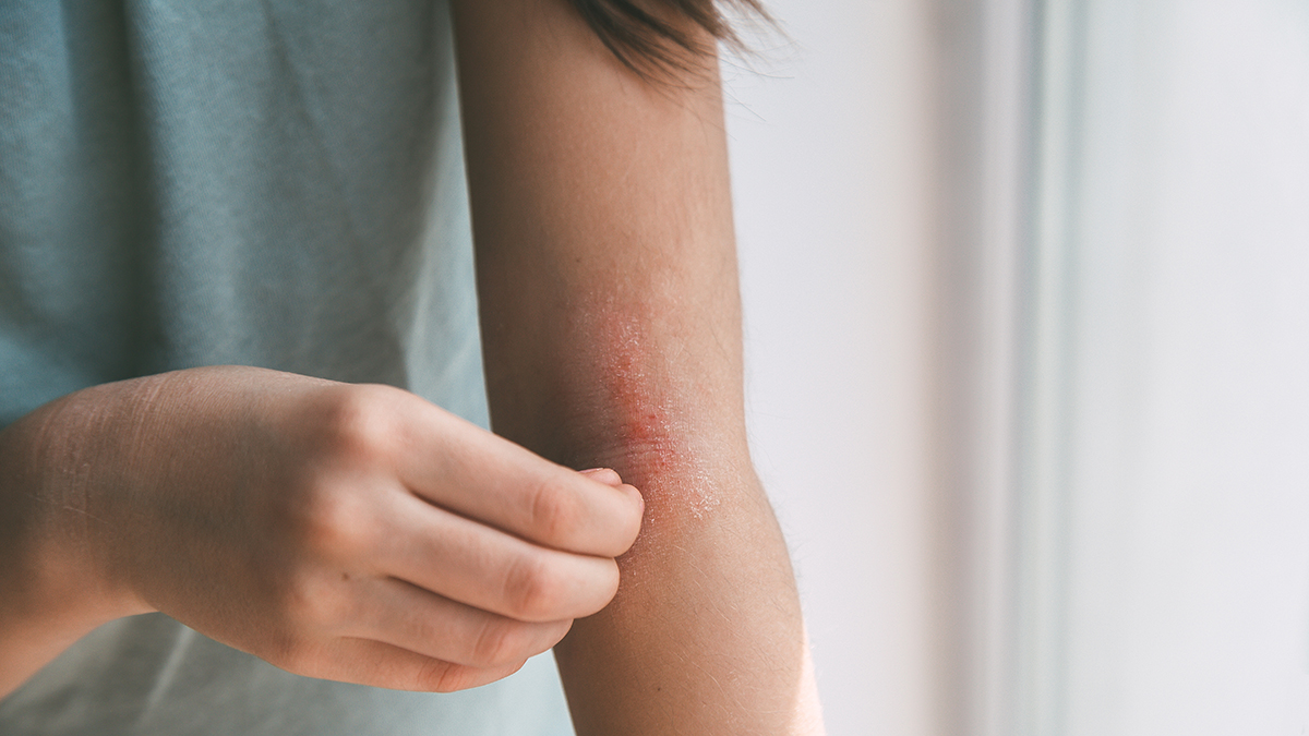 Как понять, что у вас атопический дерматит
