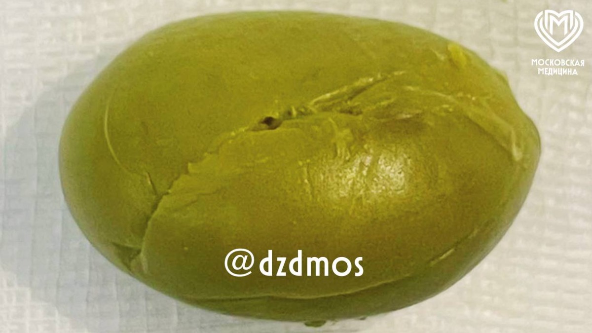 Столичные врачи спасли ребенка, у которого в желудке застряла оливка