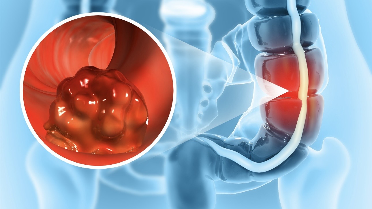 Российские вакцины от колоректального рака: что известно об их эффективности