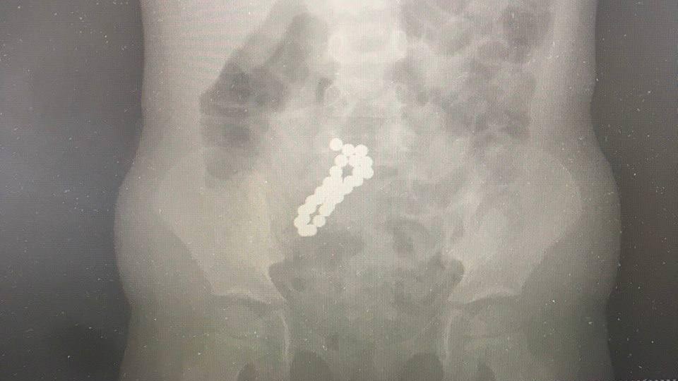 Подмосковные врачи достали из кишечника четырехлетней девочки 30 магнитов