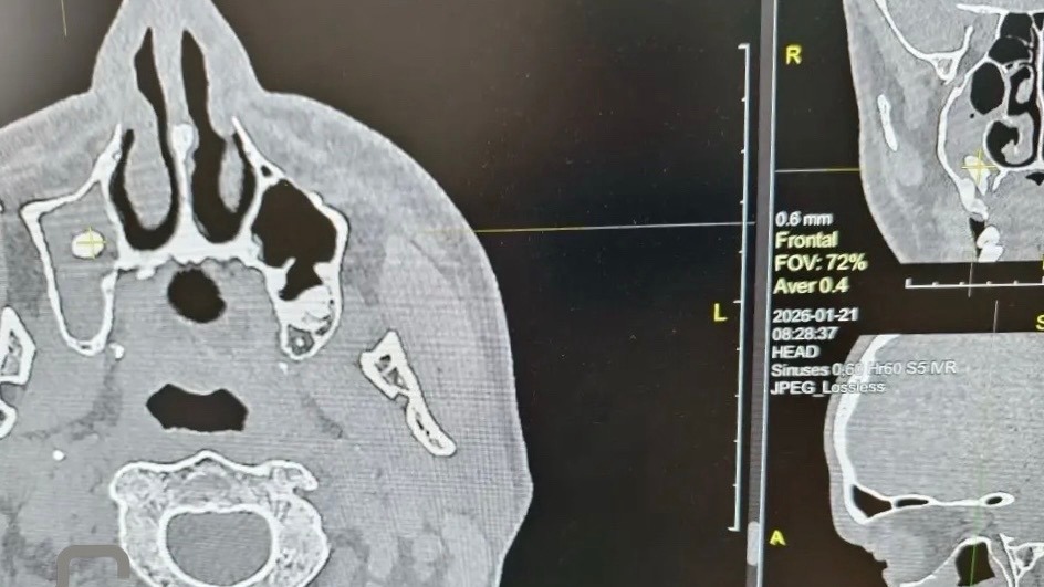 Орчанин едва не задохнулся из-за «переехавшего» в нос зуба