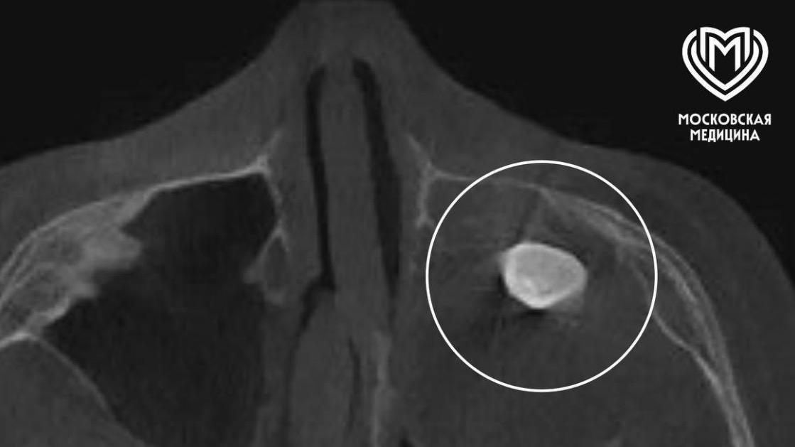 Московские врачи удалили подростку зуб, выросший в носу