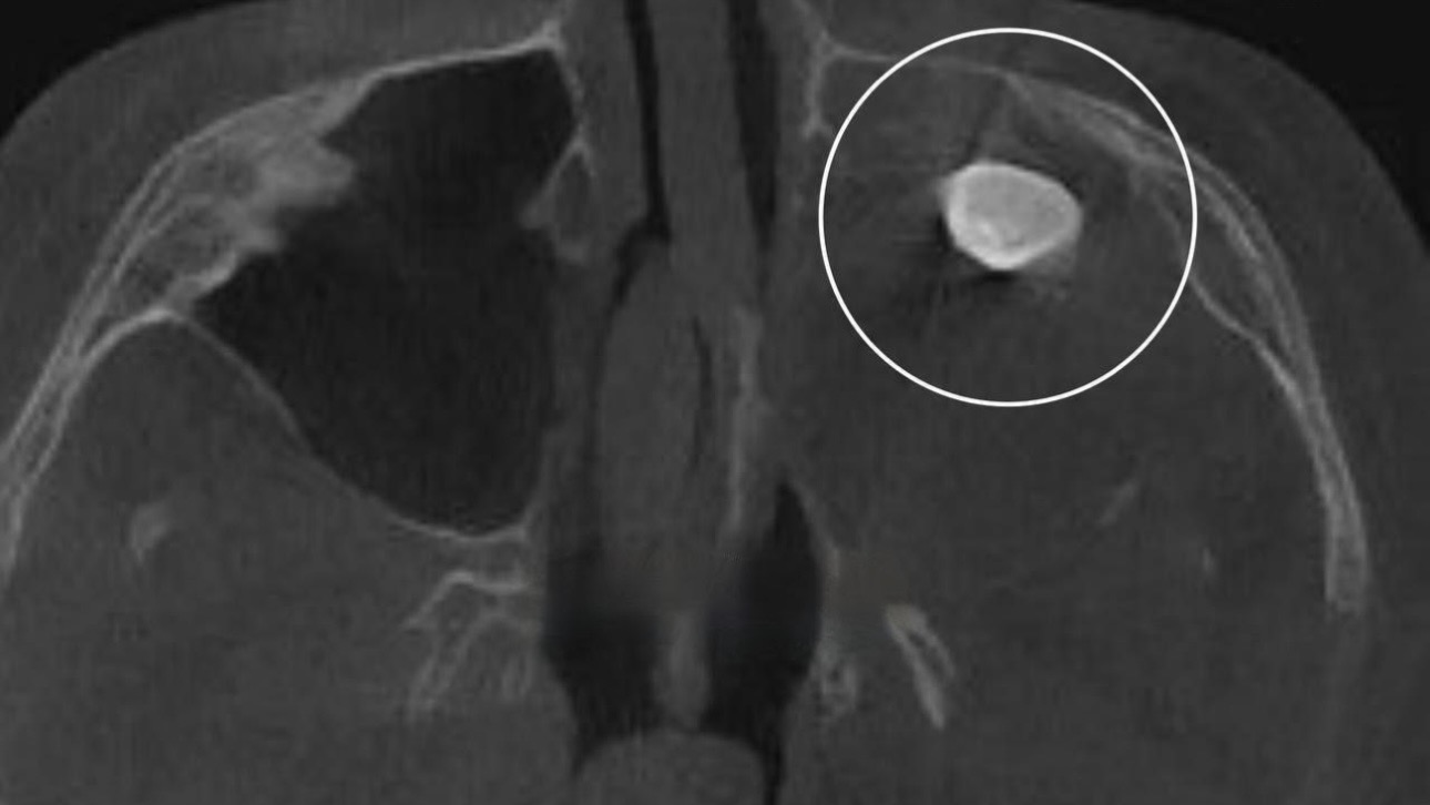 Что такое тератома 