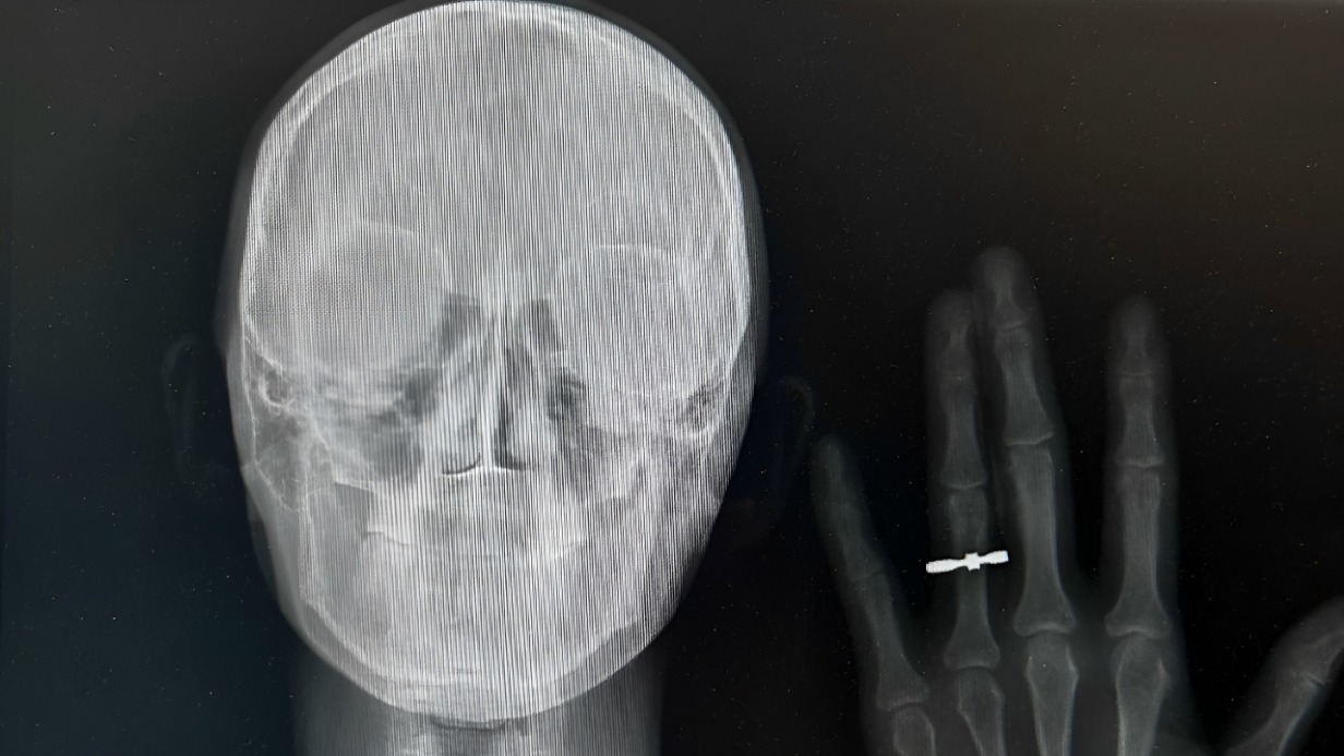 Рентгеновский снимок молодоженов из Новосибирска Кристины Шрайнер и Станислава Ефремова
