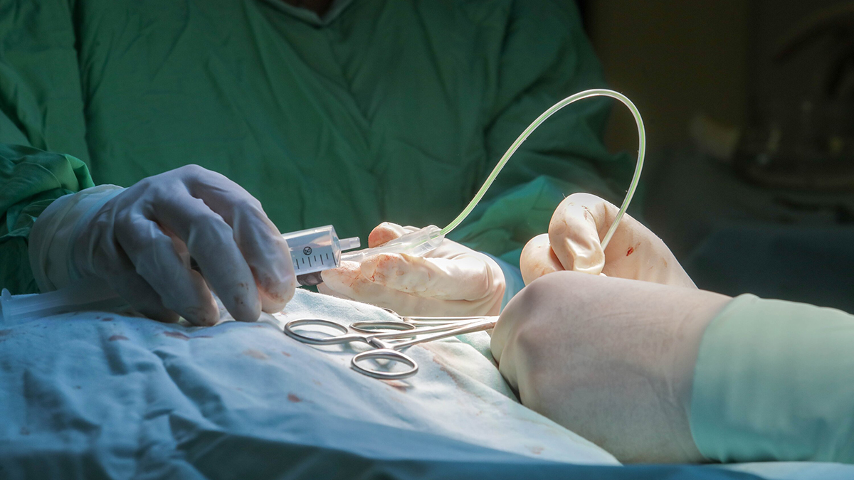 Россиянам с ожирением стала доступна хирургическая помощь по полису ОМС