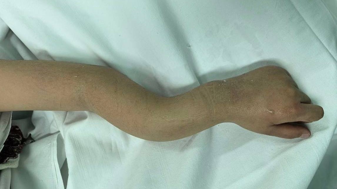 Подмосковные медики спасли ребенку руку, которая сложилась в «гармошку»