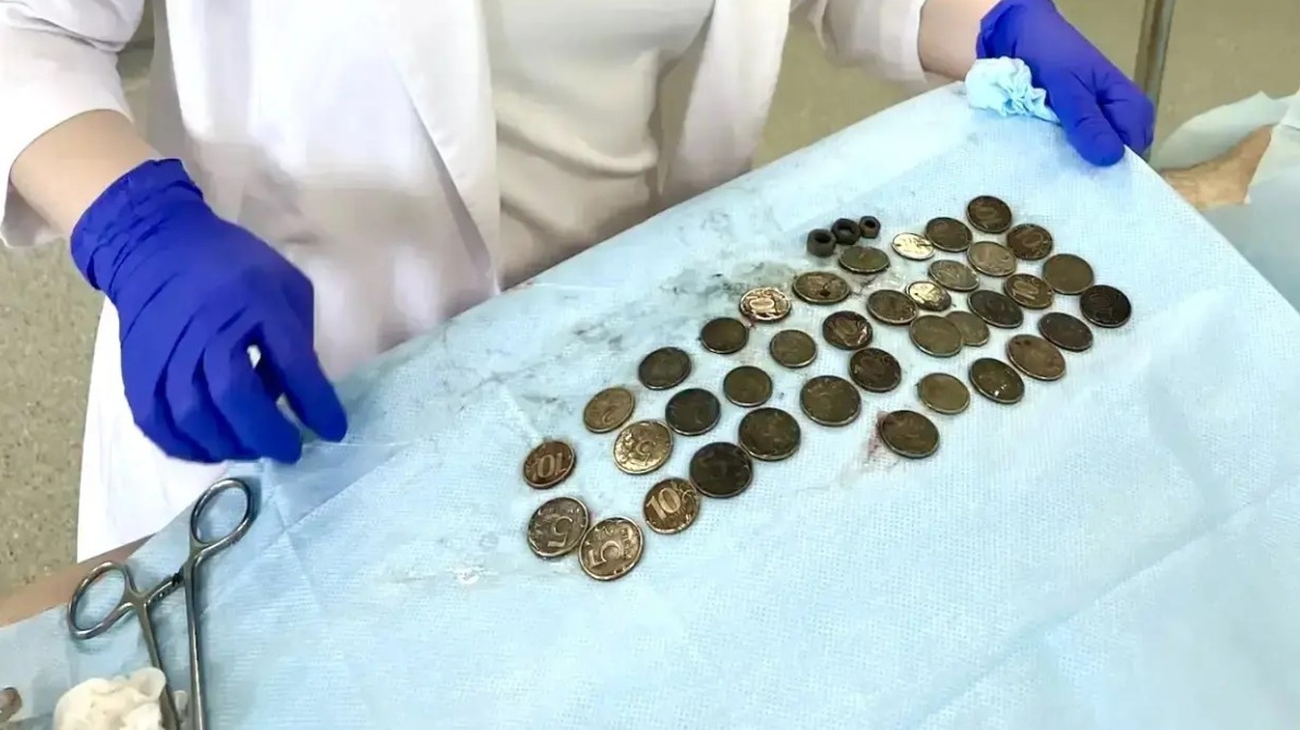 Свыше 200 монет, 11 гаек и две дверные петли извлекли из желудка волгоградца