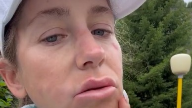 Ведущая Барановская показала усыпанное волдырями лицо и опухшие губы