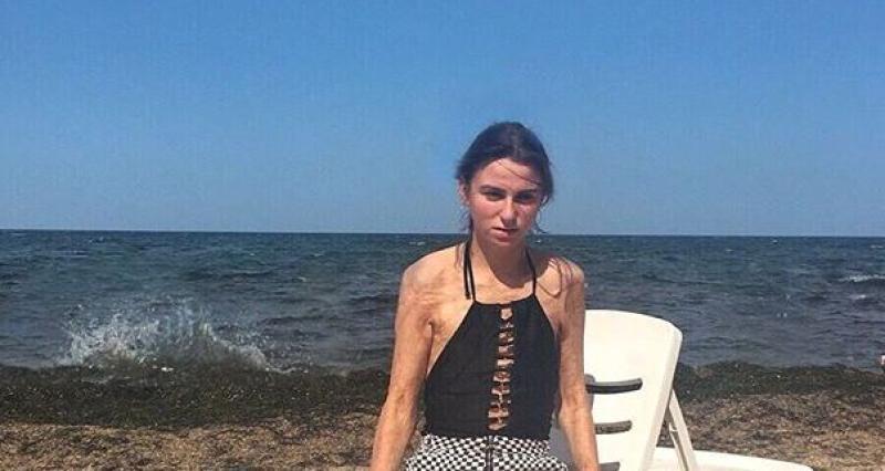 У модели Светланы Алексеевой ожоги 45 процентов тела